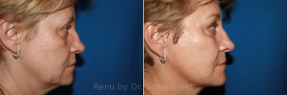 Facelift Before and After Photos in DC, Patient 8814