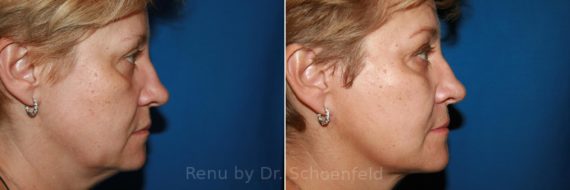 Deep Neck Lift Surgery  Potomac Plastic Surgery