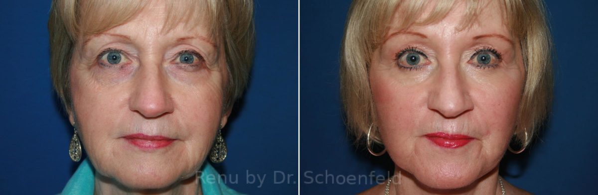 Facelift Before and After Photos in DC, Patient 8634