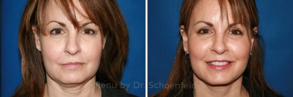 Facelift Before and After Photos in , 