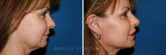 Facelift Before and After Photos in Chevy Chase, MD