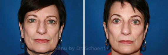 Facelift Before and After Photos in DC, Patient 7410