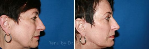 Facelift Before and After Photos in DC, Patient 7410