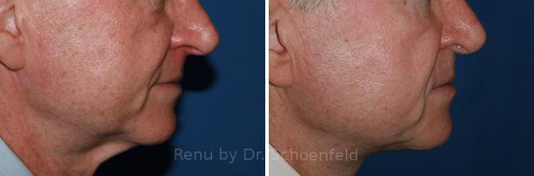 Facelift Before and After Photos in DC, Patient 7415