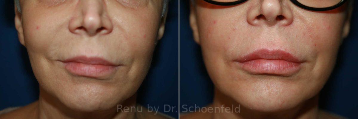 Dermal Filler Before and After Photos in DC, Patient 9967