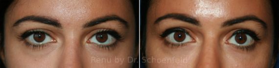 Dermal Filler Before and After Photos in DC, Patient 9881