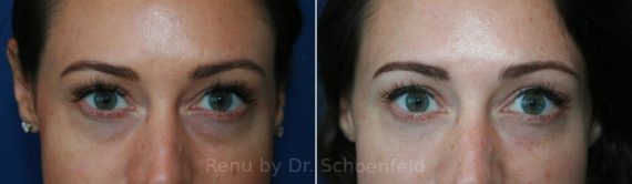 Dermal Filler Before and After Photos in DC, Patient 9547