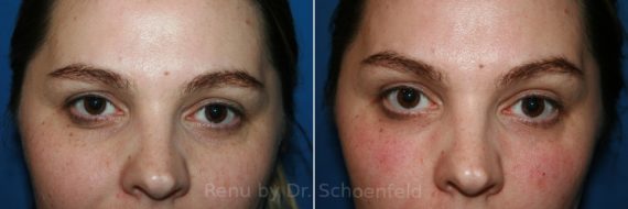 Dermal Filler Before and After Photos in DC, Patient 9042