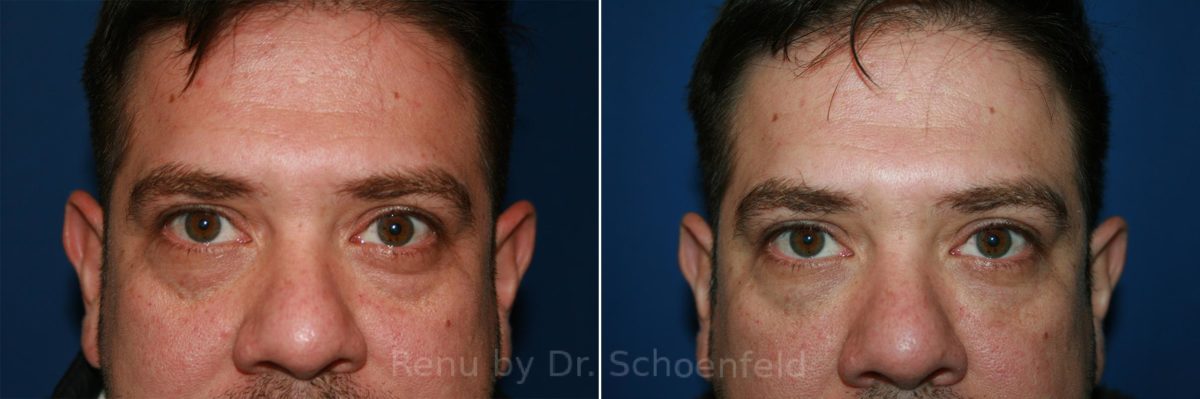 Dermal Filler Before and After Photos in DC, Patient 8996