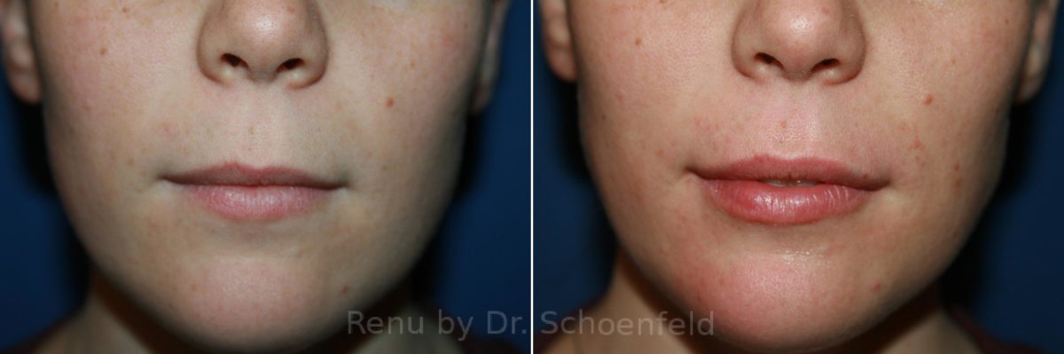 Dermal Filler Before and After Photos in DC, Patient 8977