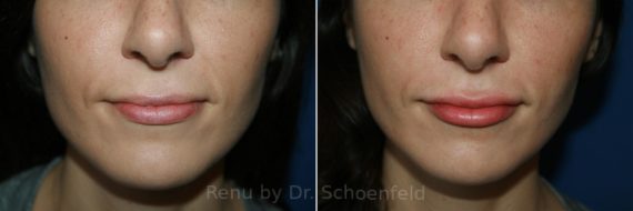 Dermal Filler Before and After Photos in DC, Patient 8876