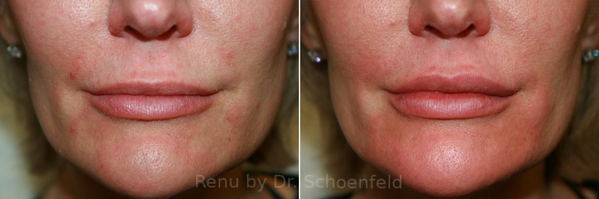 Dermal Filler Before and After Photos in DC, Patient 8881