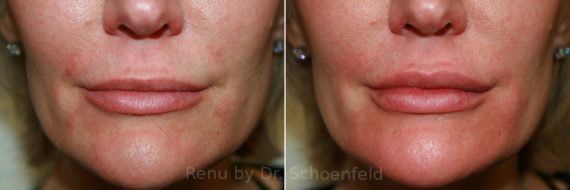 Dermal Filler Before and After Photos in DC, Patient 8881