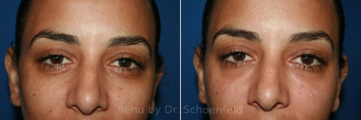 Dermal Filler Before and After Photos in DC, Patient 8573