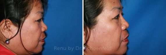 Dermal Filler Before and After Photos in DC, Patient 7346