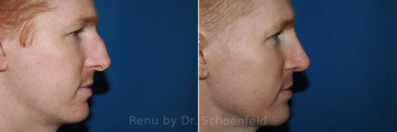 Rhinoplasty Before and After Photos in DC, Patient 10494