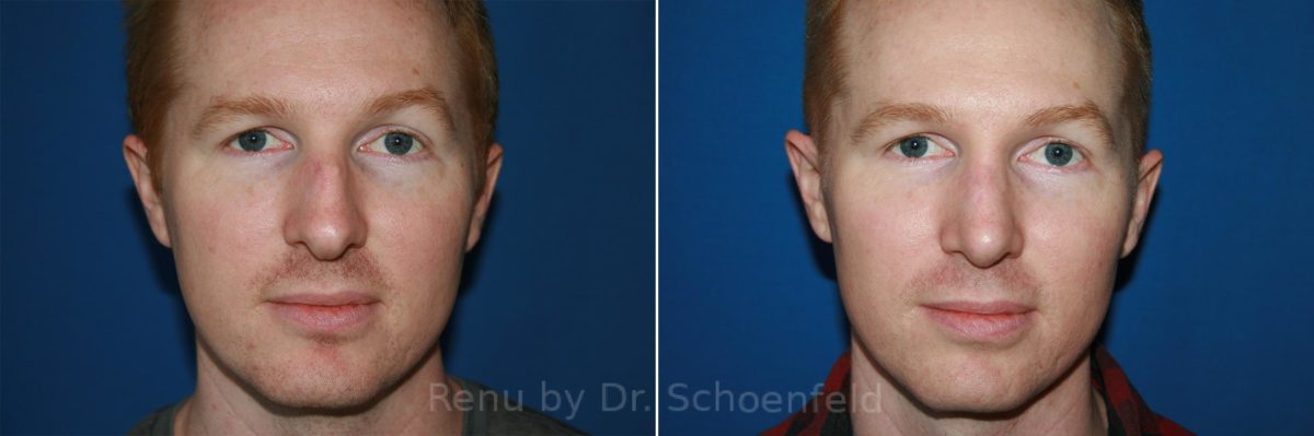 Rhinoplasty Before and After Photos in DC, Patient 10494