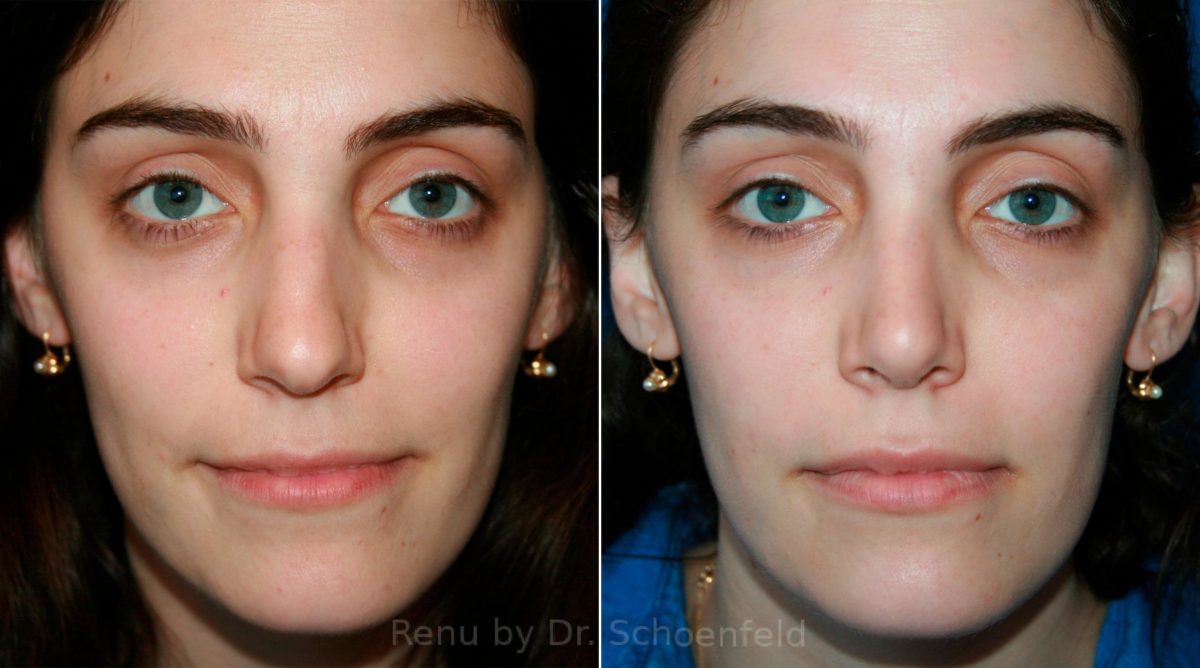 Rhinoplasty Before and After Photos in DC, Patient 11855