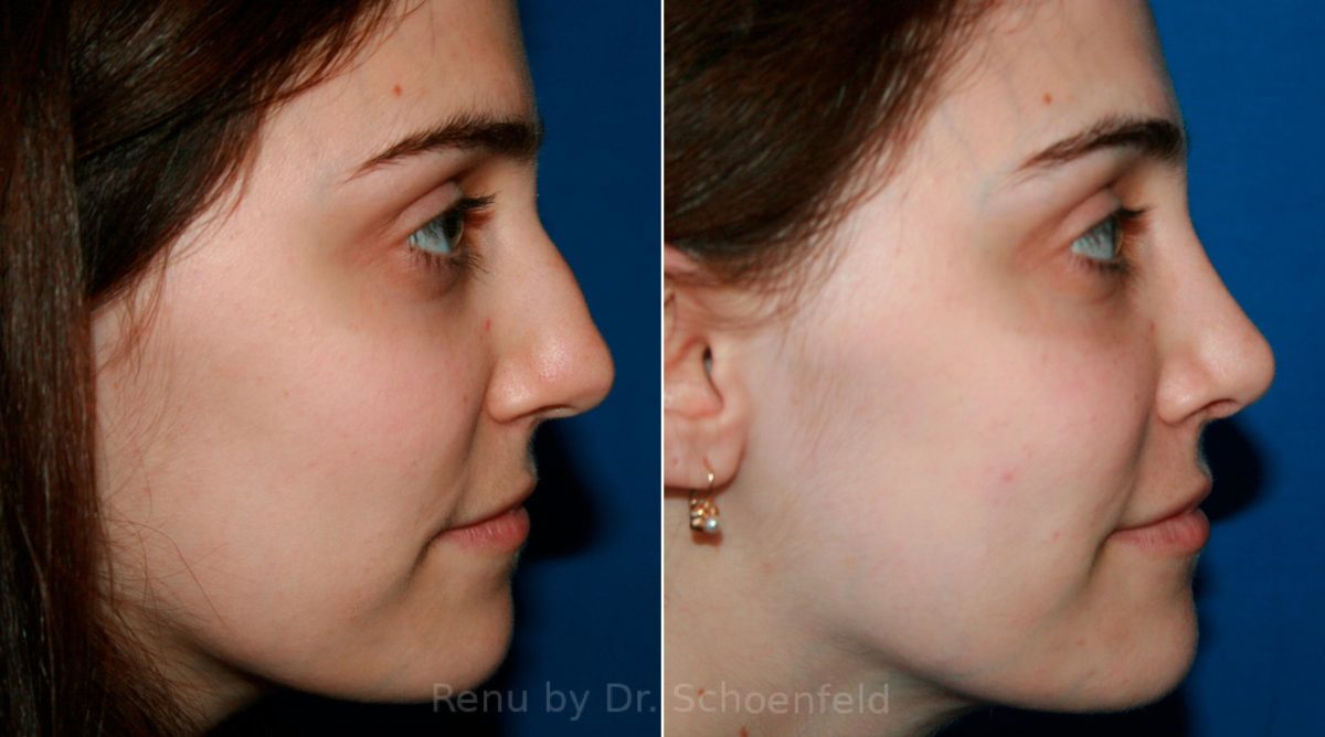 Rhinoplasty Before and After Photos in DC, Patient 11855