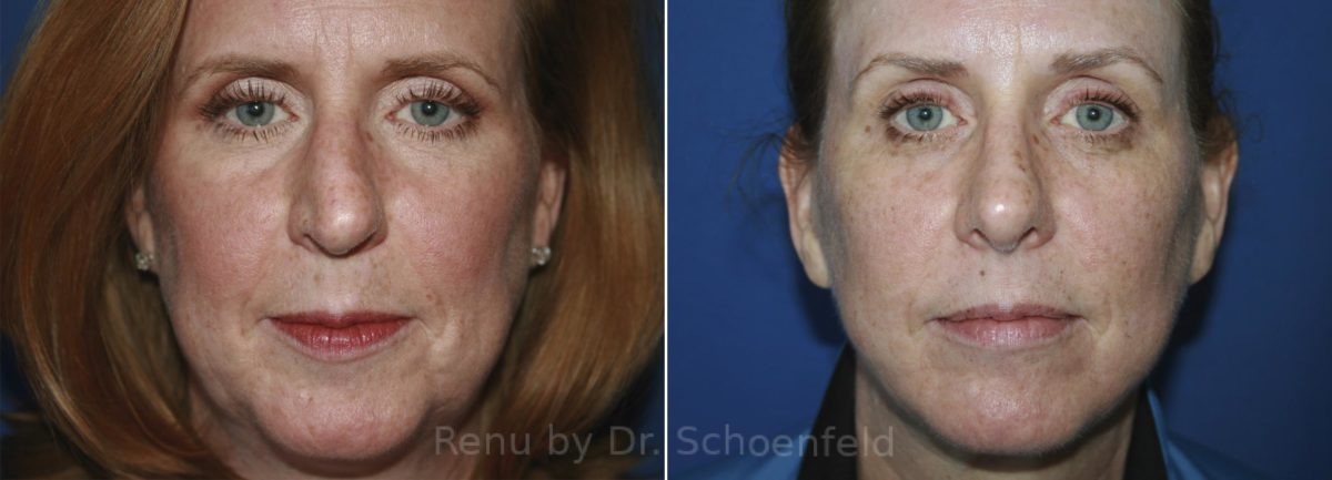 Facelift Before and After Photos in DC, Patient 11888