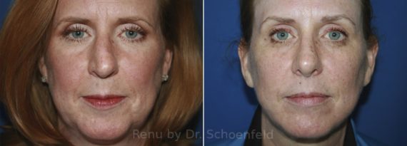 Facelift Before and After Photos in DC, Patient 11888