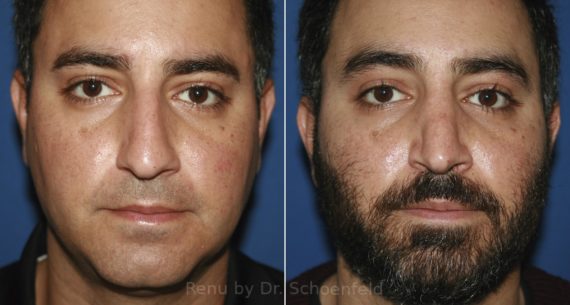 Rhinoplasty Before and After Photos in DC, Patient 11895