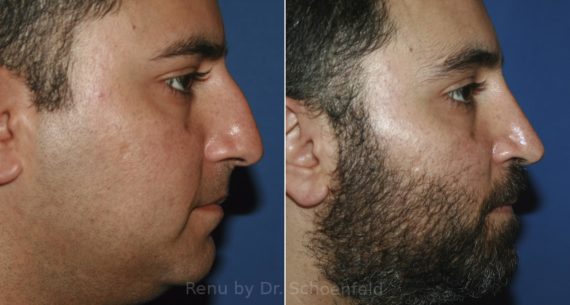 Rhinoplasty Before and After Photos in DC, Patient 11895