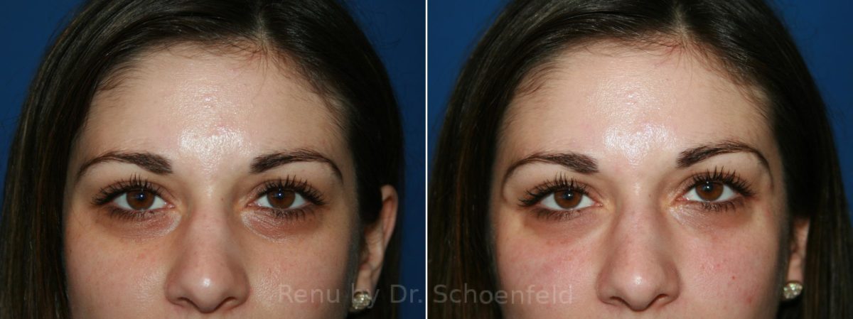 Dermal Filler Before and After Photos in DC, Patient 12000