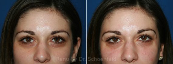 Dermal Filler Before and After Photos in DC, Patient 12000