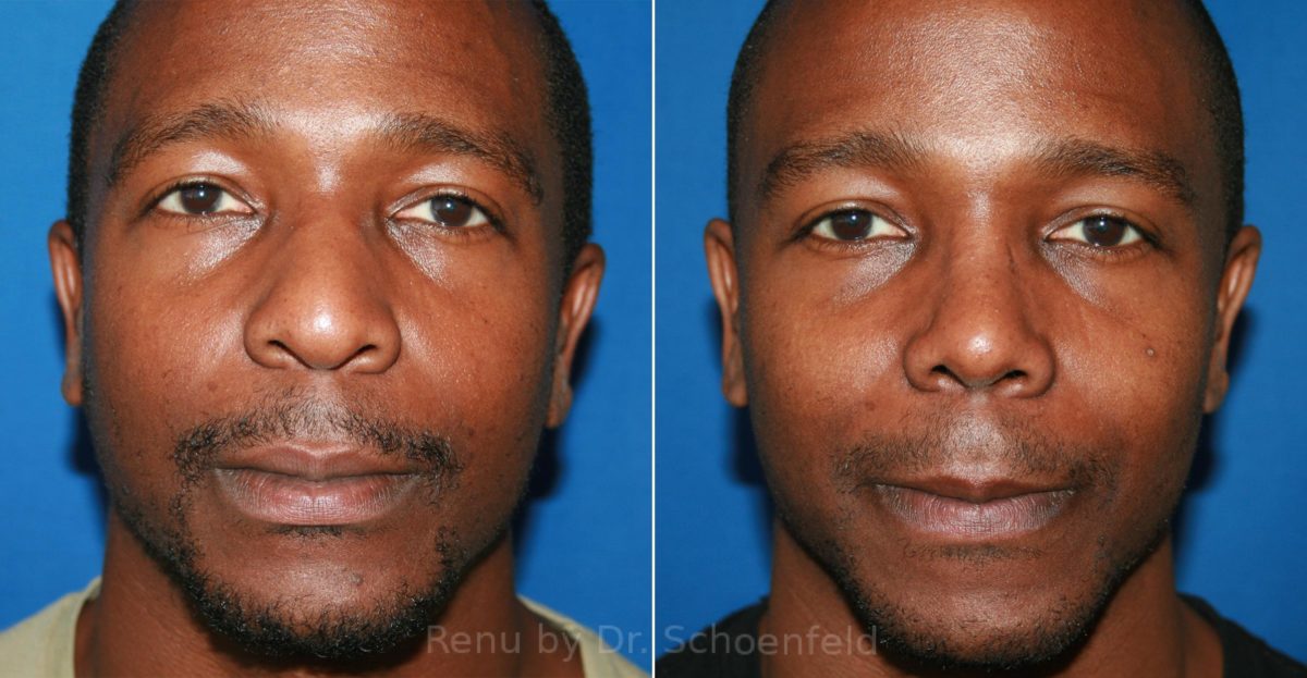 Rhinoplasty Before and After Photos in DC, Patient 12006