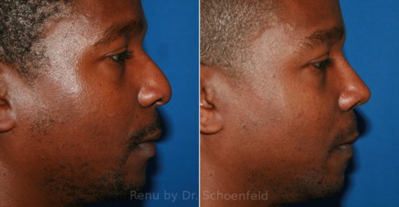 Rhinoplasty Before and After Photos in DC, Patient 12006
