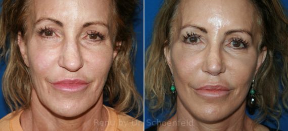 Facelift Before and After Photos in DC, Patient 12143