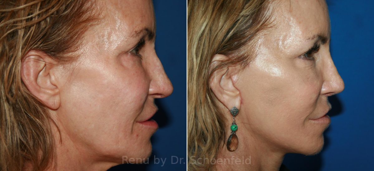 Facelift Before and After Photos in DC, Patient 12143