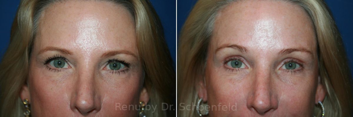 Blepharoplasty Before and After Photos in DC, Patient 12052