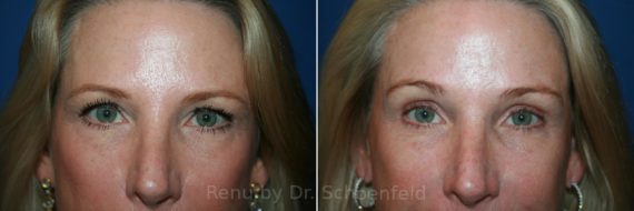 Blepharoplasty Before and After Photos in DC, Patient 12052