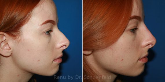 Non-Surgical Rhinoplasty Before and After Photos in DC, Patient 12059