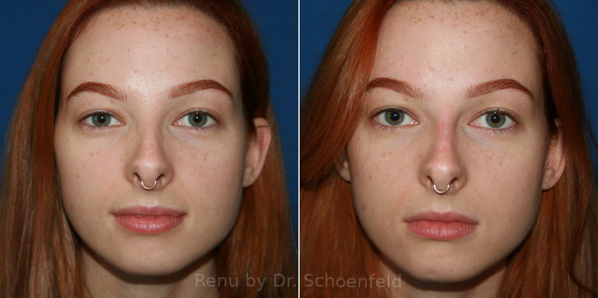 Non-Surgical Rhinoplasty Before and After Photos in DC, Patient 12059