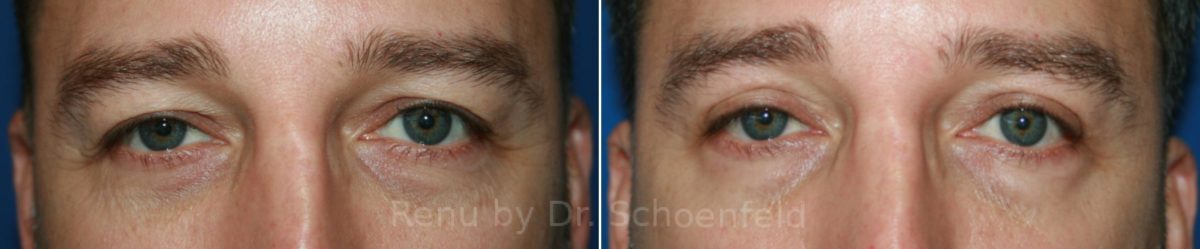 Blepharoplasty Before and After Photos in DC, Patient 12081