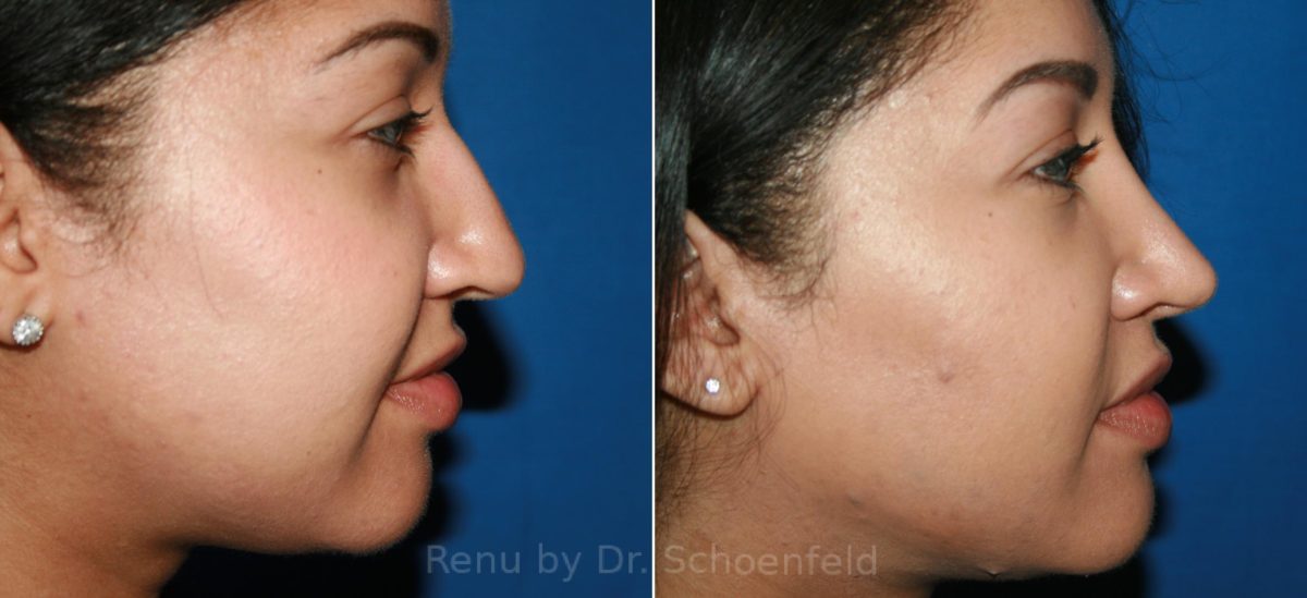 Rhinoplasty Before and After Photos in DC, Patient 12098