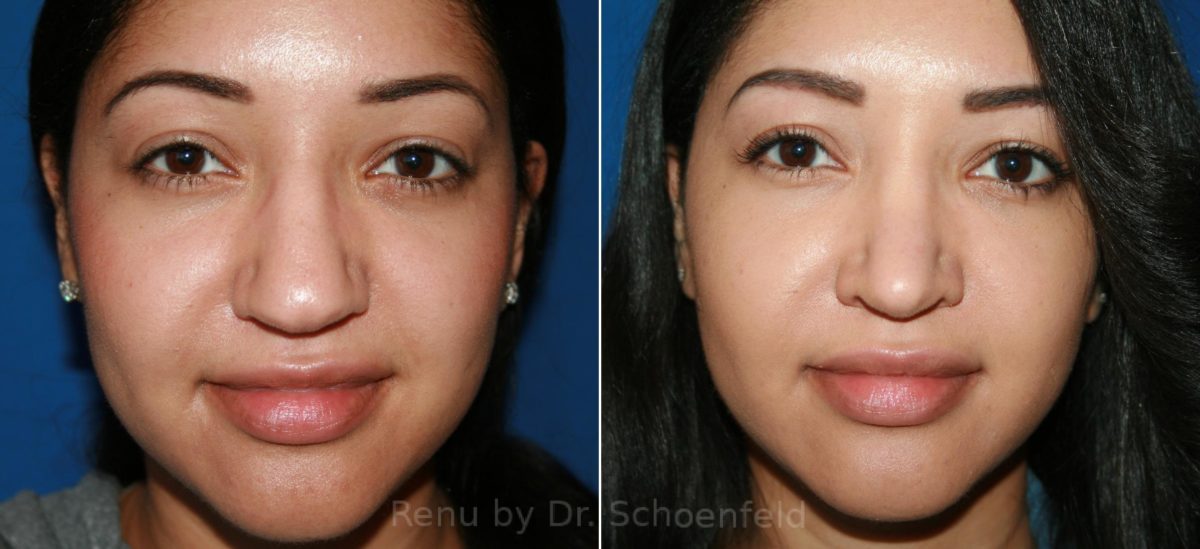 Rhinoplasty Before and After Photos in DC, Patient 12098
