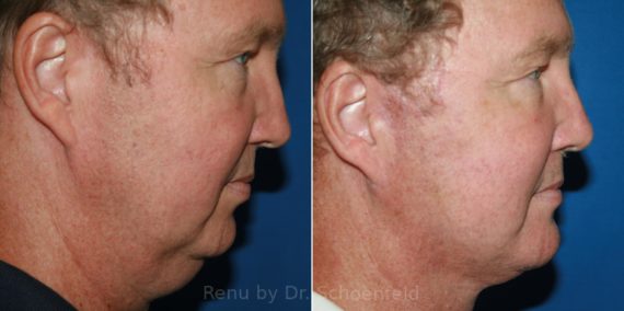 Facelift Before and After Photos in DC, Patient 12120