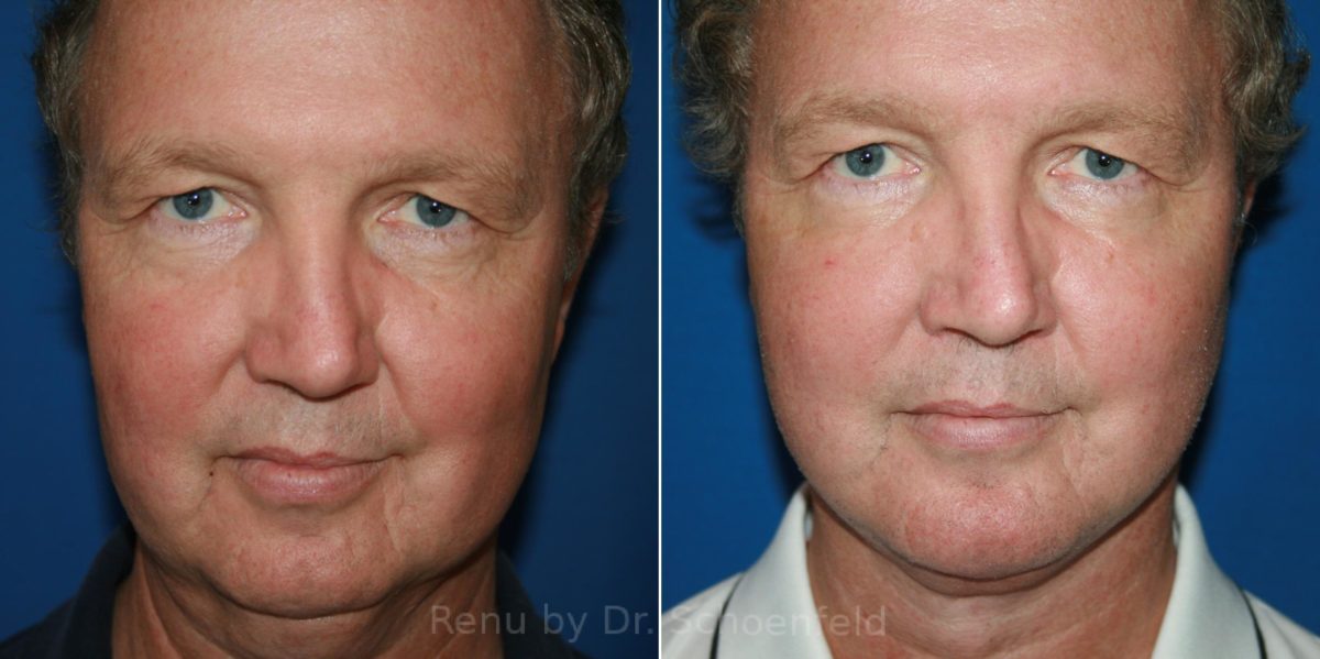 Facelift Before and After Photos in DC, Patient 12120