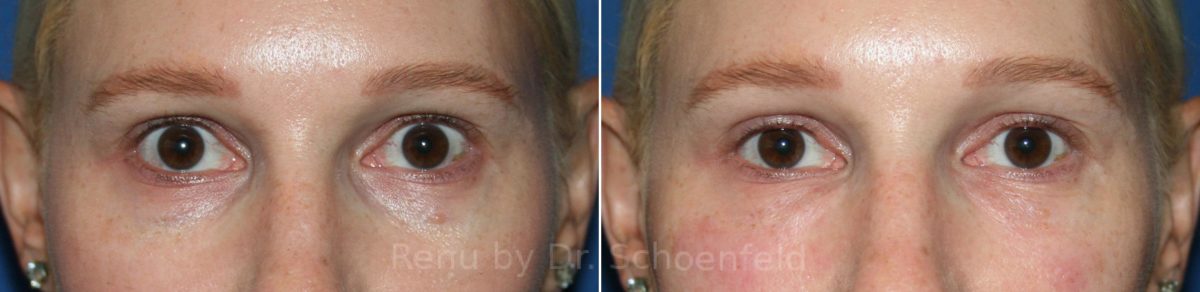 Dermal Filler Before and After Photos in DC, Patient 12241