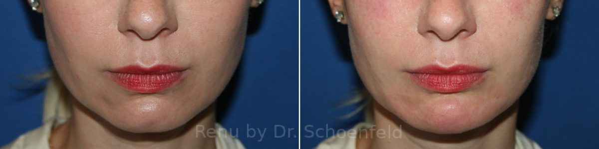 Chin Implant Before and After Photos in DC, Patient 12240