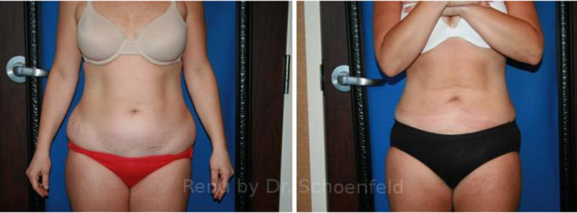 Laser Liposuction Before-and-After Photos