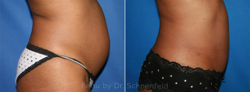 Laser Liposuction Before-and-After Photos