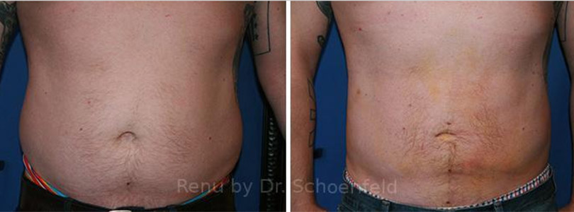 Laser Liposuction Before-and-After Photos