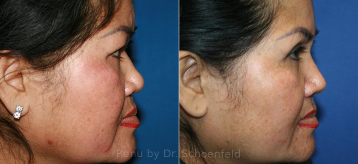 Rhinoplasty Before and After Photos in DC, Patient 12277