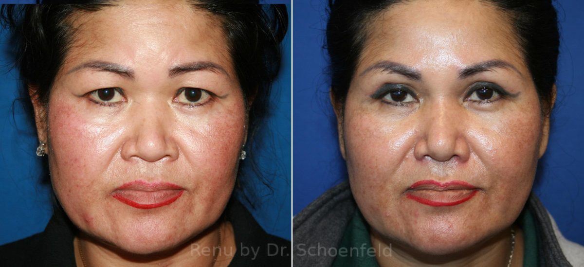 Patient 12277, Rhinoplasty Before and After Photos Rhinoplasty Before and After Photos in DC, Patient 12277