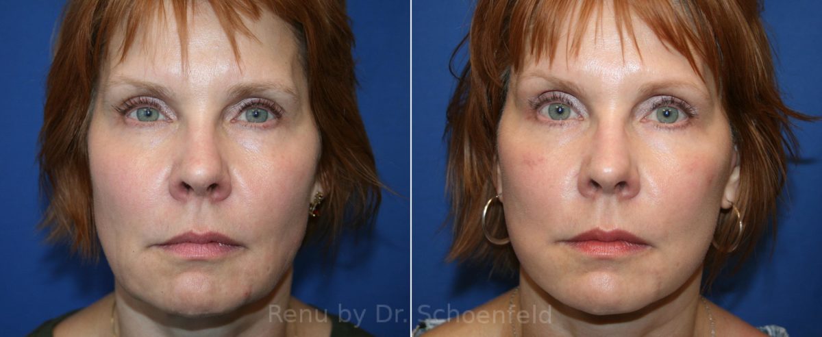 Facelift Before and After Photos in DC, Patient 12394
